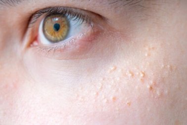 É possível tratar a queratose pilar com remédios naturais?