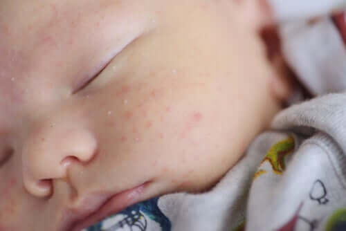 Tratamento da crosta láctea e acne neonatal