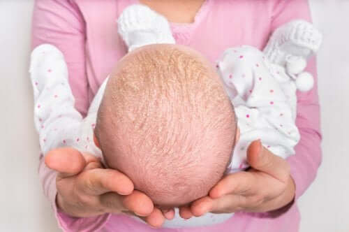 Bebê com crosta láctea