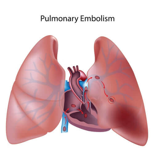 Tudo o que você precisa saber sobre a tromboembolia pulmonar