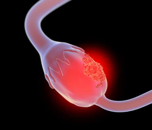 O que é o cistoadenoma mucinoso gigante de ovário?