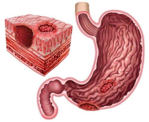 Lceras P Pticas E Helicobacter Pylori Melhor Com Sa De