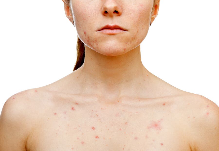 Mulher com acne hormonal