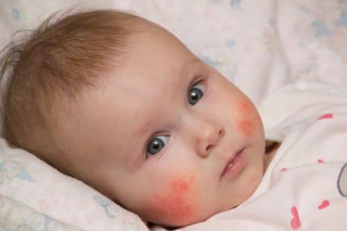 Bebê com dermatite no rosto