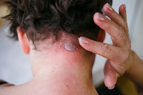 Dermatite seborreica: sintomas e tratamento