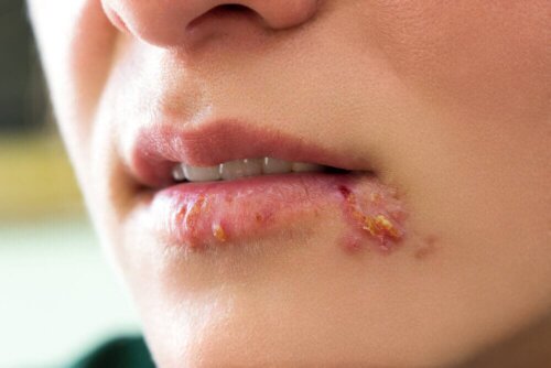 Infecção nos lábios