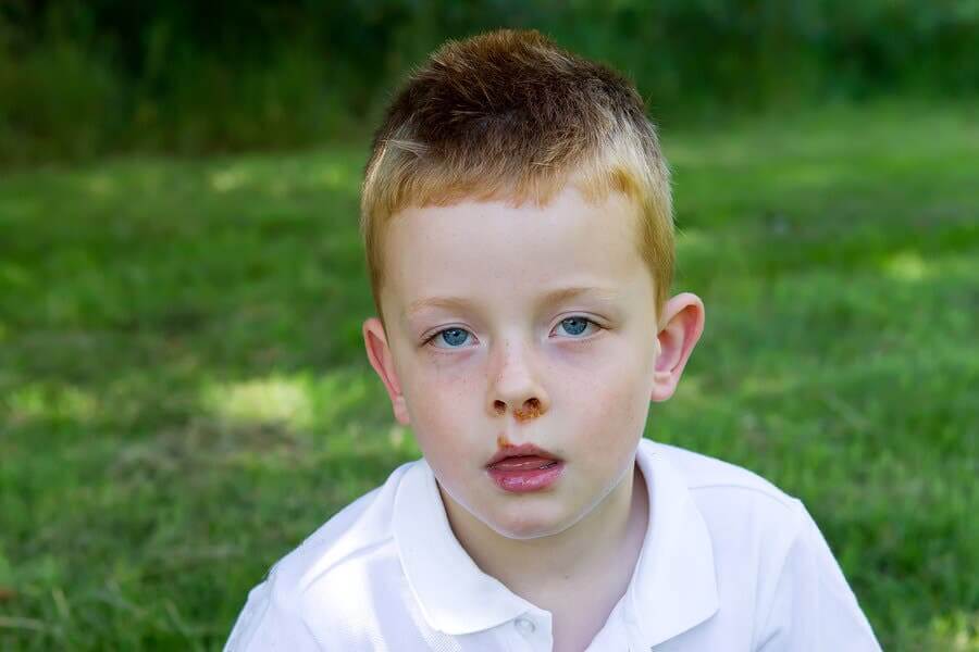 Impetigo: sintomas e causas