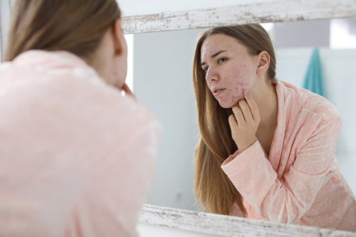 Acne hormonal: causas e tratamentos