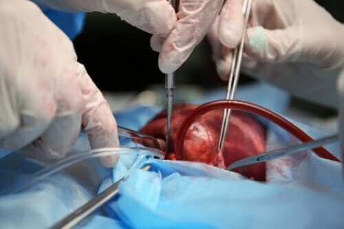 Cirurgia cardíaca