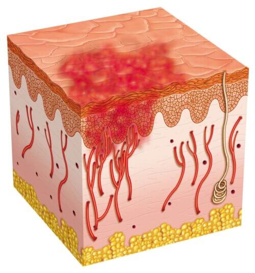 Úlcera nas camadas da pele