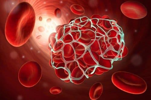 Causas de um infarto intestinal mesentérico