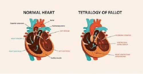 Esquema da tetralogia de Fallot