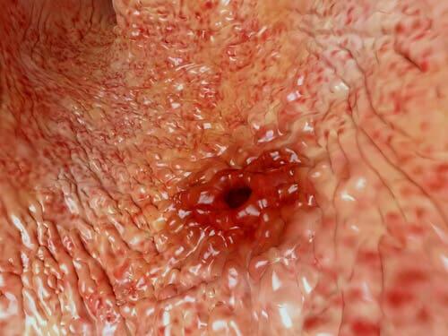 O que são as úlceras e quantos tipos existem?