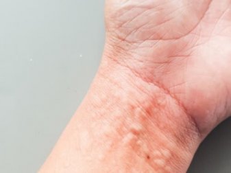 Como a urticária crônica afeta a qualidade de vida?
