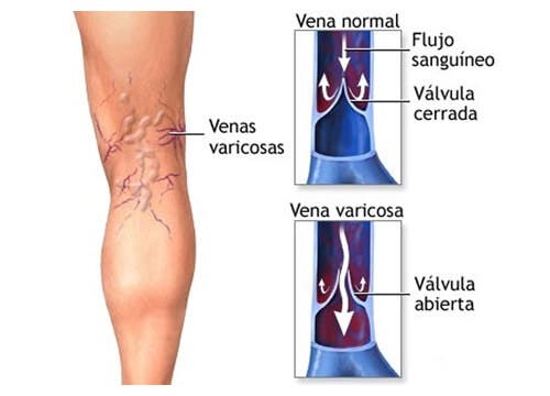 Veias nas pernas