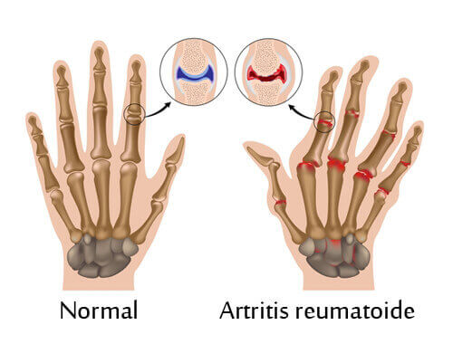 Artrite e artrose