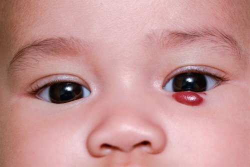 O que são os hemangiomas infantis?