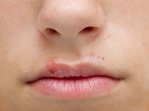 Herpes no lábio