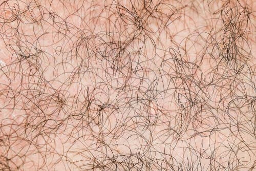 Hipertricose ou síndrome do lobisomem