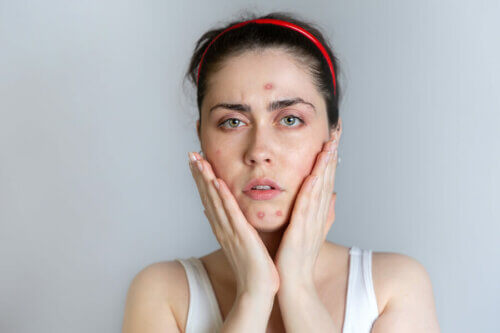 Mulher com acne