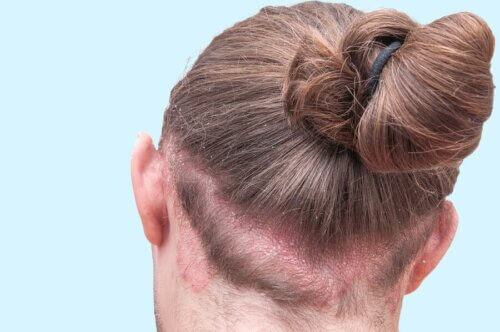 Mulher com dermatite