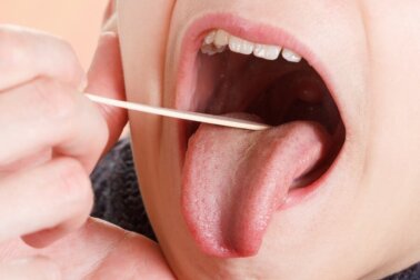 Placas na garganta: sintomas e tratamento