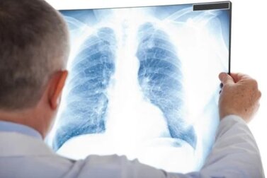 Embolia pulmonar: sintomas e tratamento