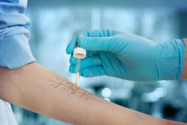 O que são os testes de alergia e como eles funcionam?