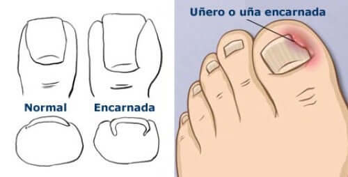 Como prevenir as unhas encravadas?