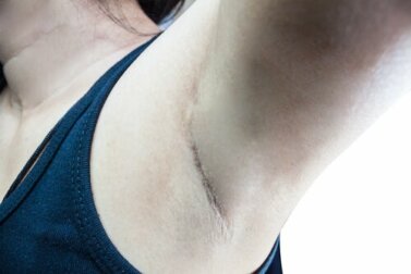 O que é o linfonodo sentinela?