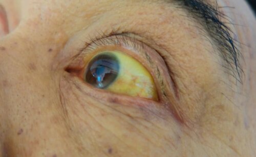 Olhos amarelados