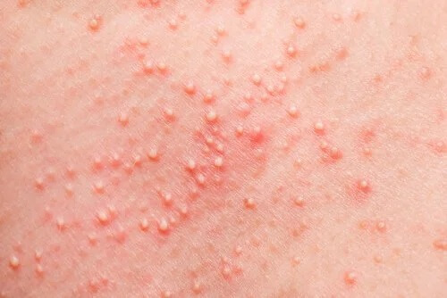 Reação alérgica na pele