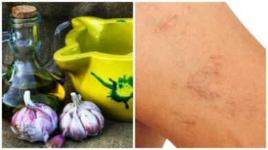 Tratamento com azeite e alho para combater as varizes e vasinhos