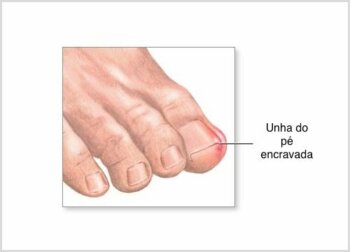 Como cortar as unhas e evitar que elas encravem?