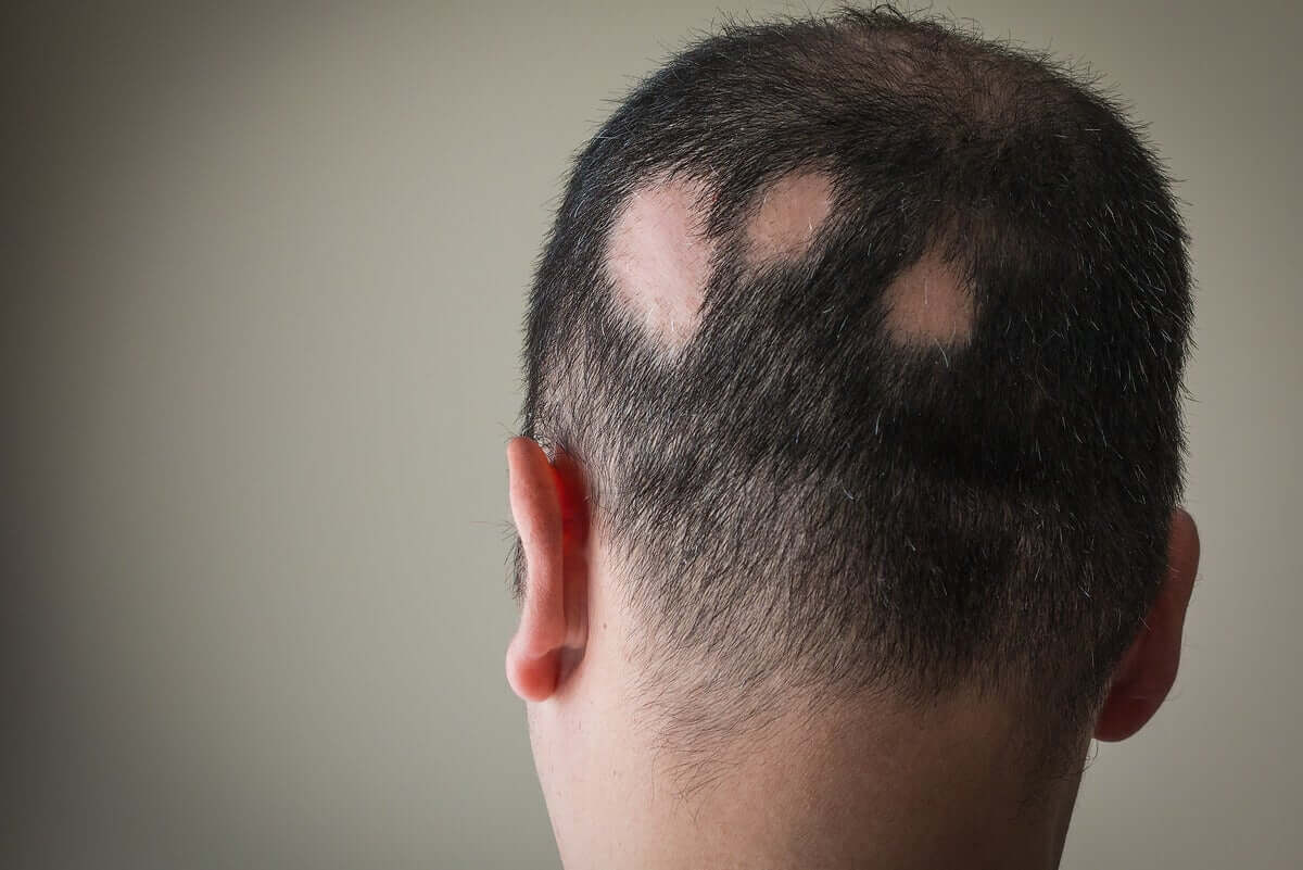 Tipos de alopecia 