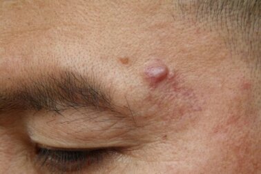 Cistos epidermoides: causas e possíveis tratamentos