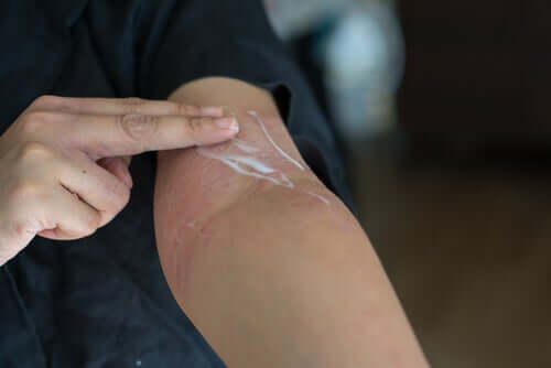 Alguns cremes podem provocar dermatite