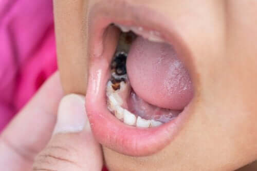 Cáries nos dentes