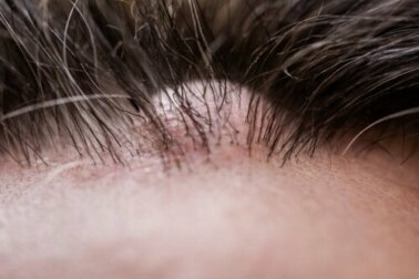 O que é um dermatofibroma?