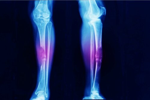 Osteossarcoma