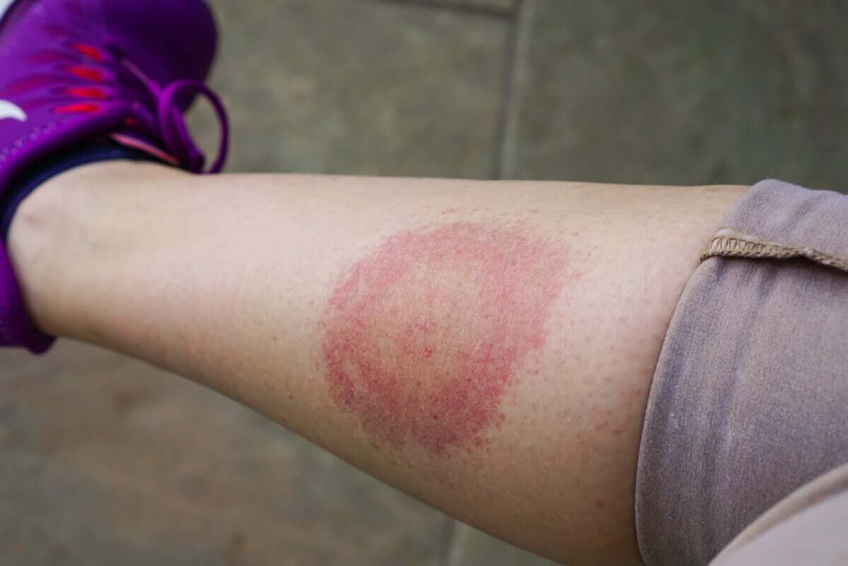 Tratamento da doença de Lyme