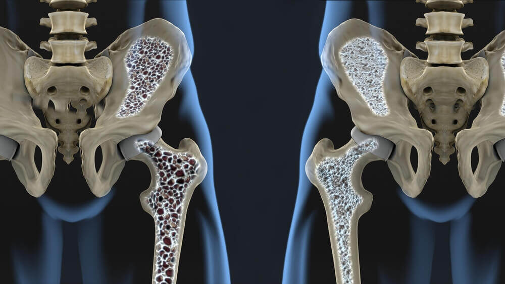 Fatores de risco para a osteoporose