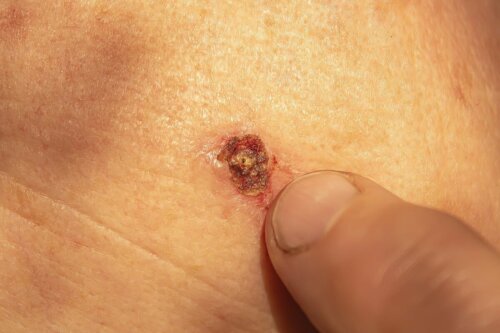 Verruga com sangue