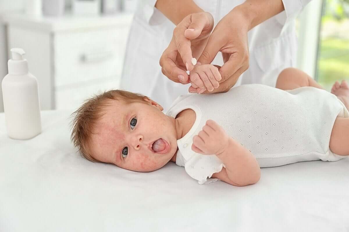 Bebê com alergia na pele