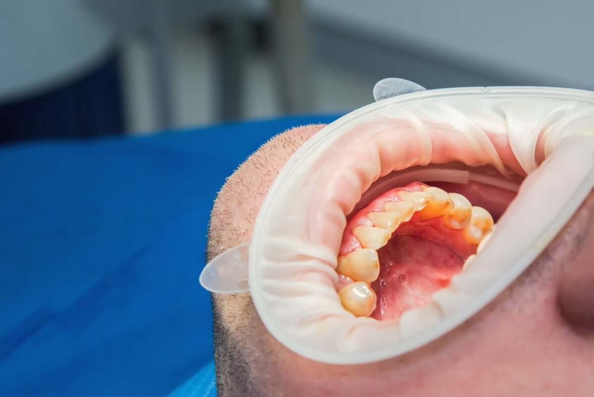 O vinagre de maçã pode ter um impacto negativo nos dentes