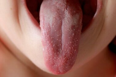 A escarlatina é contagiosa?