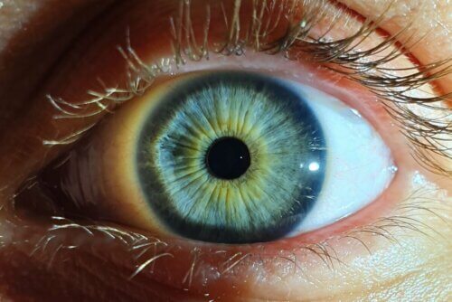 Miose nos olhos