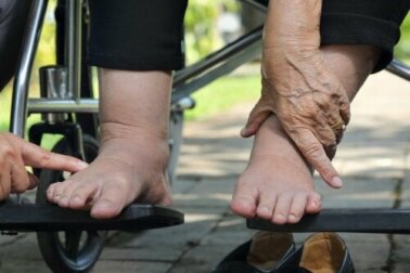 Dicas para cuidar do pé diabético no verão
