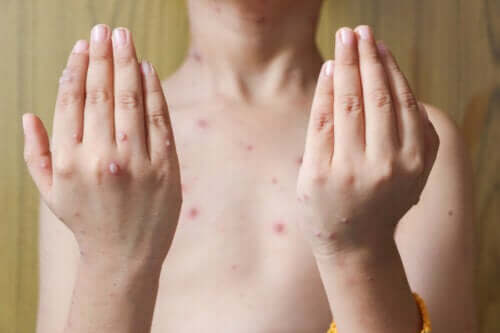Herpes-zóster em crianças: causas, sintomas e tratamentos