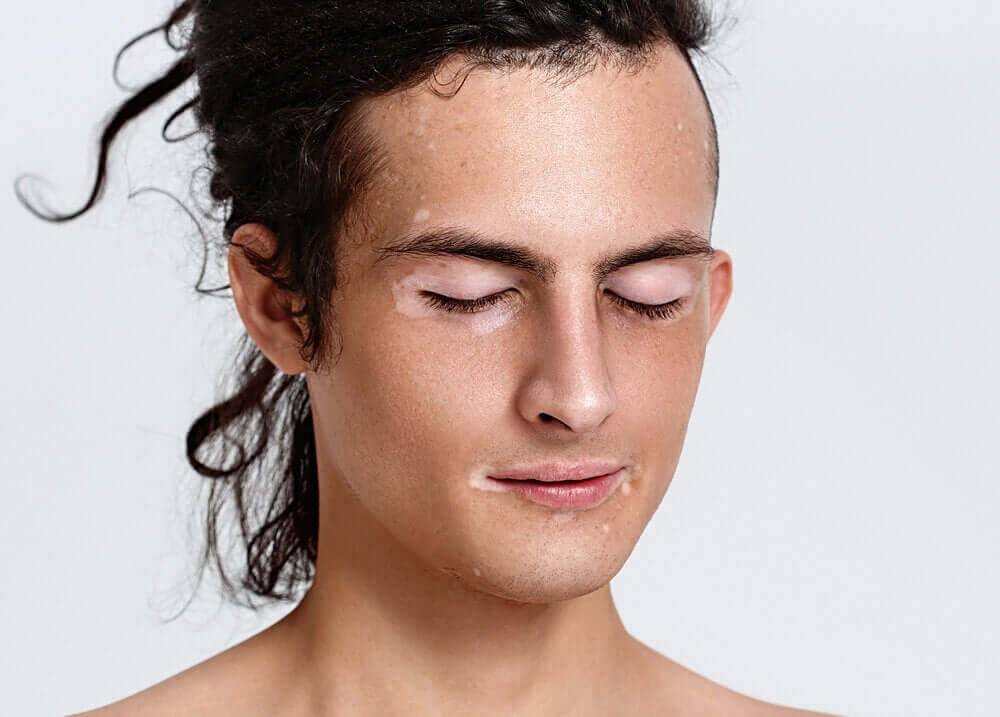 Vitiligo no rosto